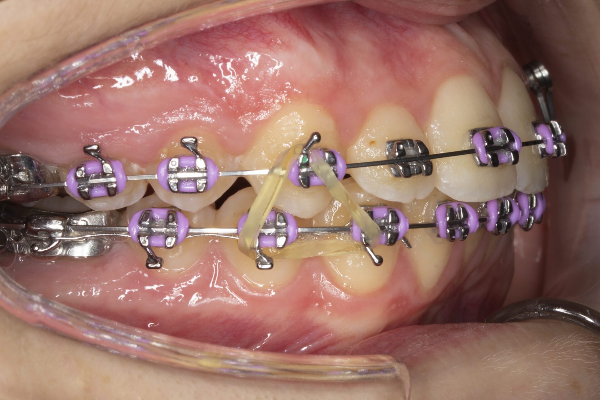 Foto intraoral derecha a los 20 meses
