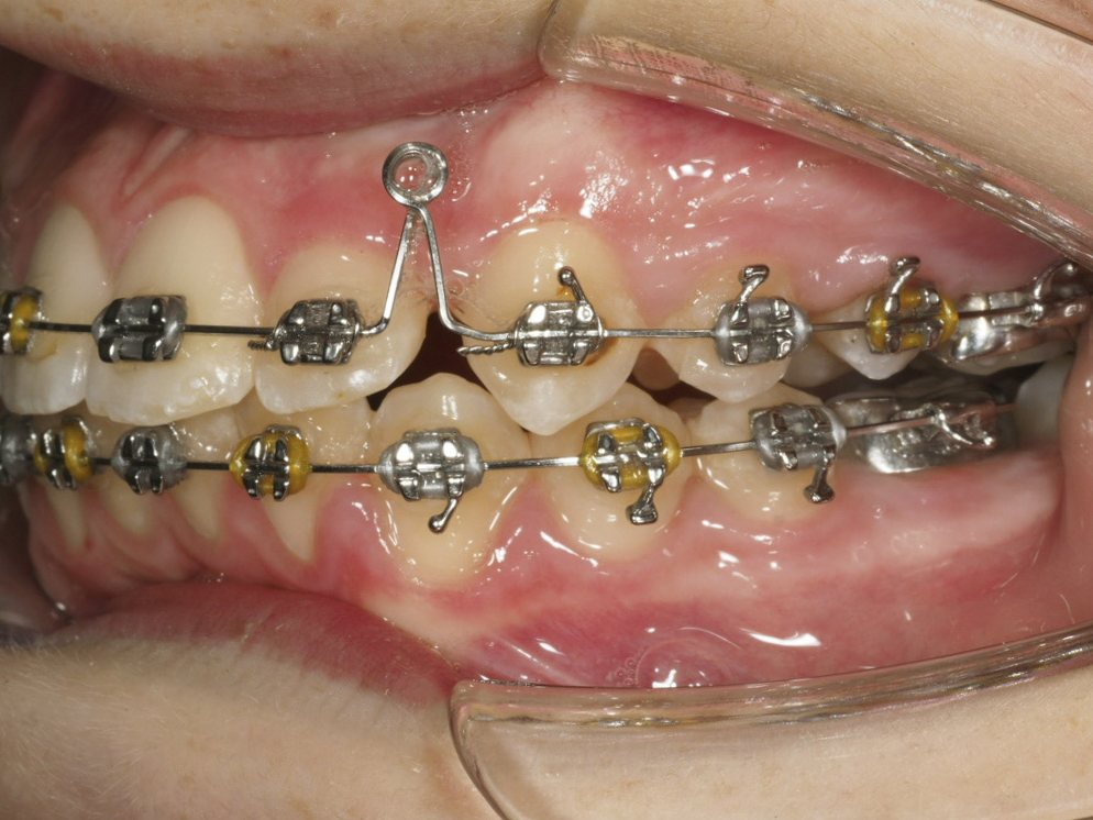 Foto intraoral izquierda a los 17 meses con arcos de acero