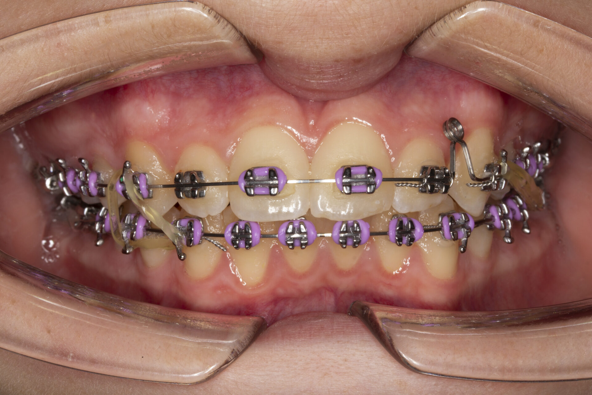 Foto intraoral frontal a los 20 meses
