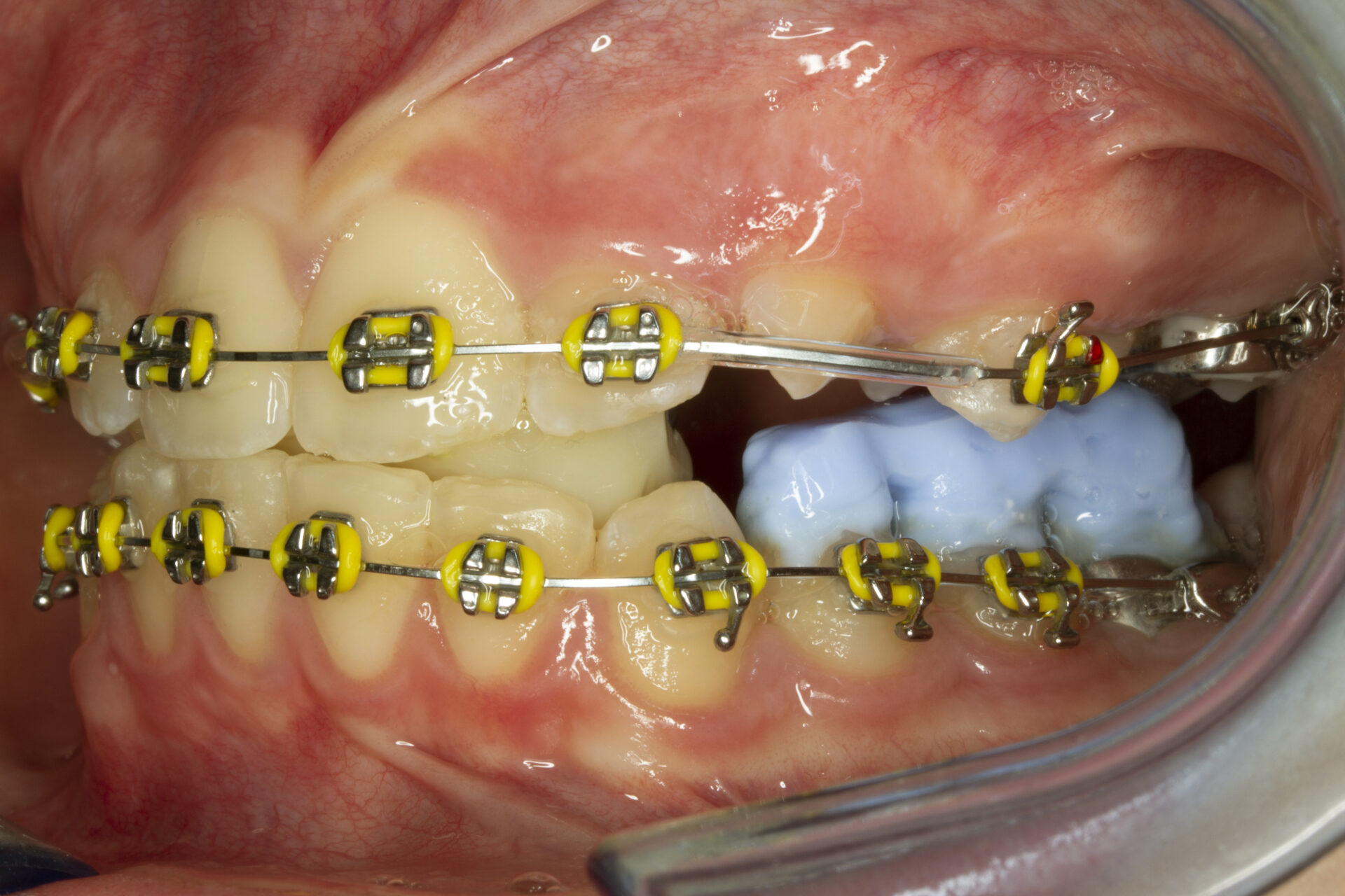 Foto intraoral izquierda tras inicio del tratamiento activo