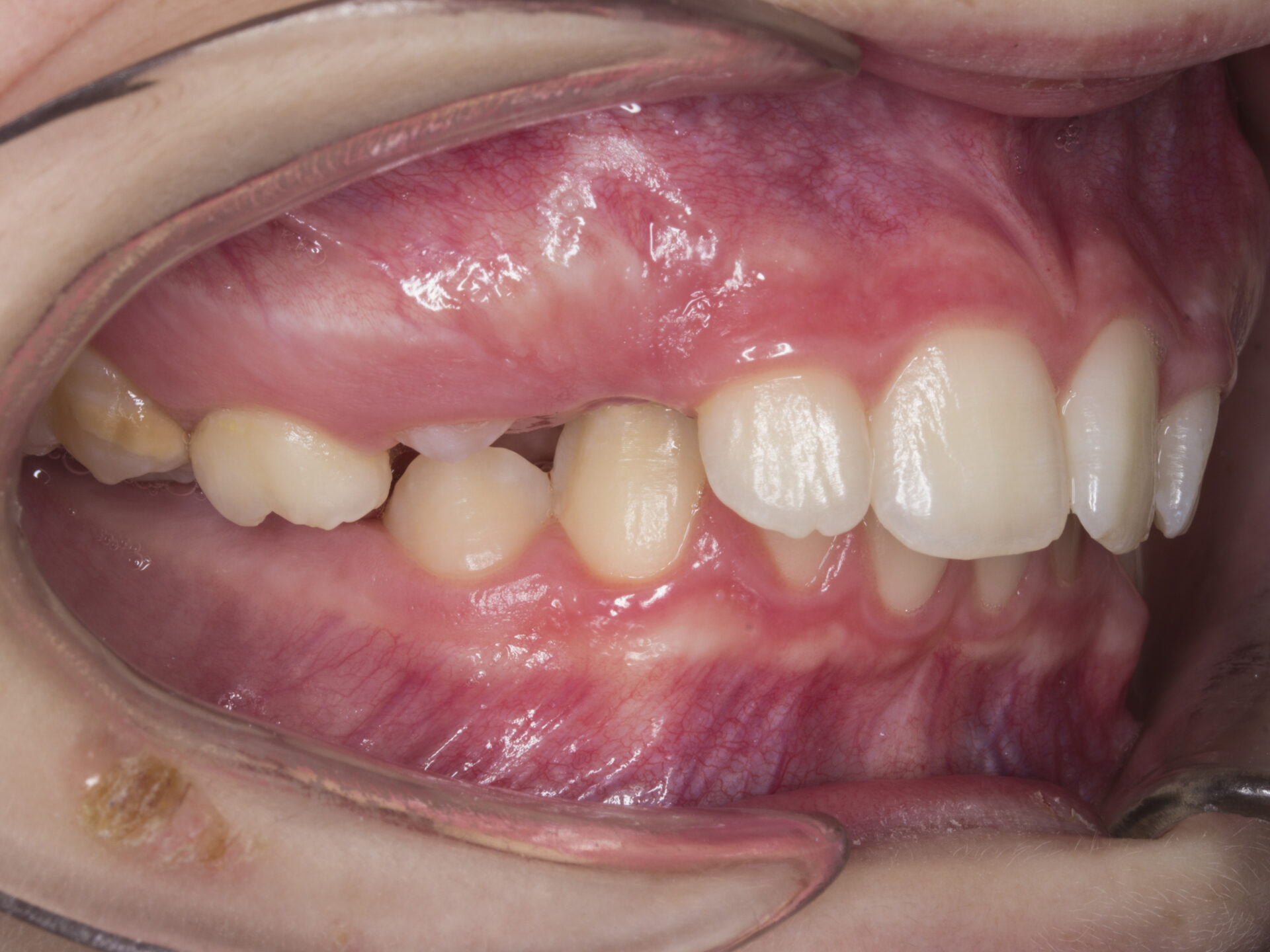 Fotografía intraoral lateral derecha — inicio del tratamiento