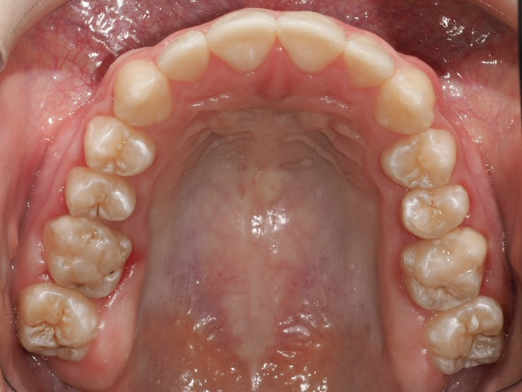 Foto oclusal del maxilar superior al final del tratamiento
