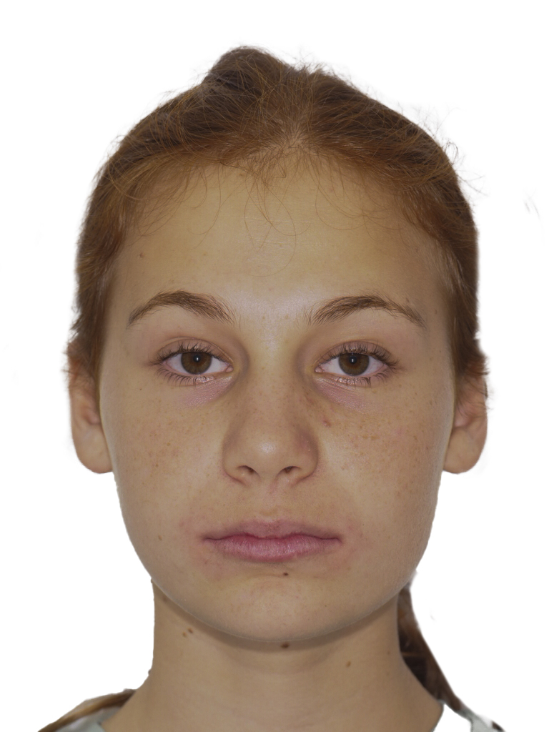 Fotografía facial frontal en reposo al final del tratamiento