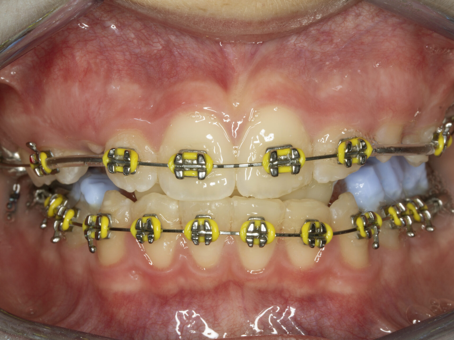 Foto intraoral frontal con brackets y estructura colada sobre implantes palatinos