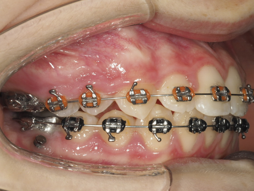 Foto intraoral derecha a los 11 meses de tratamiento