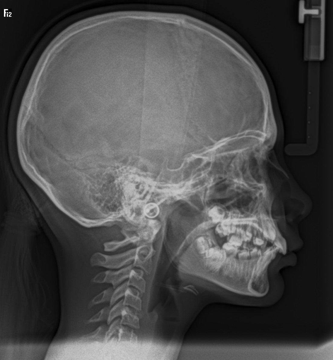 Telerradiografía lateral de cráneo — inicio del tratamiento
