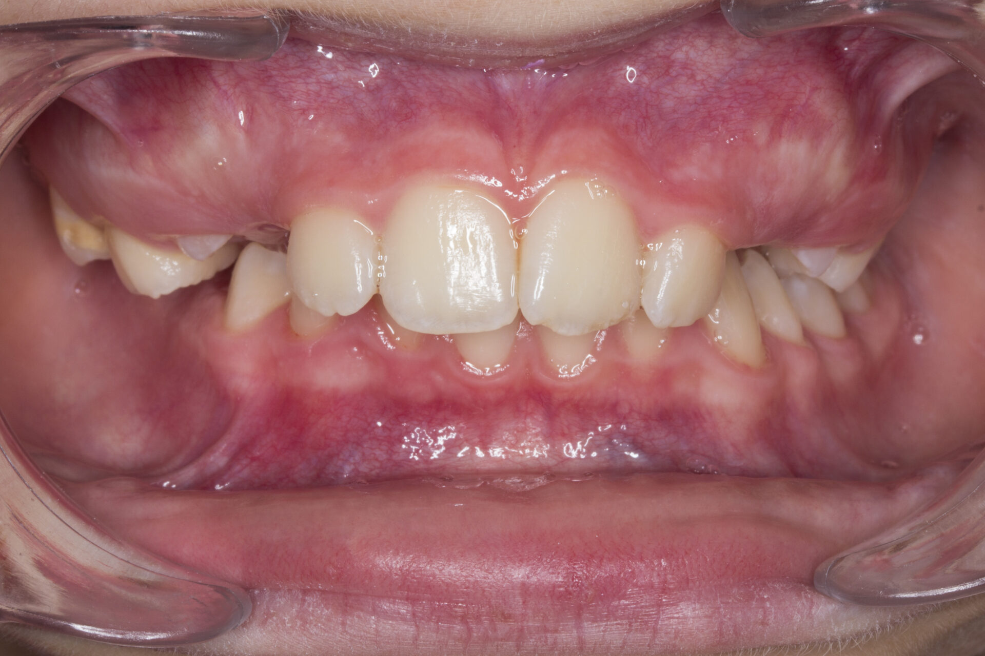 Fotografía intraoral frontal — inicio del tratamiento