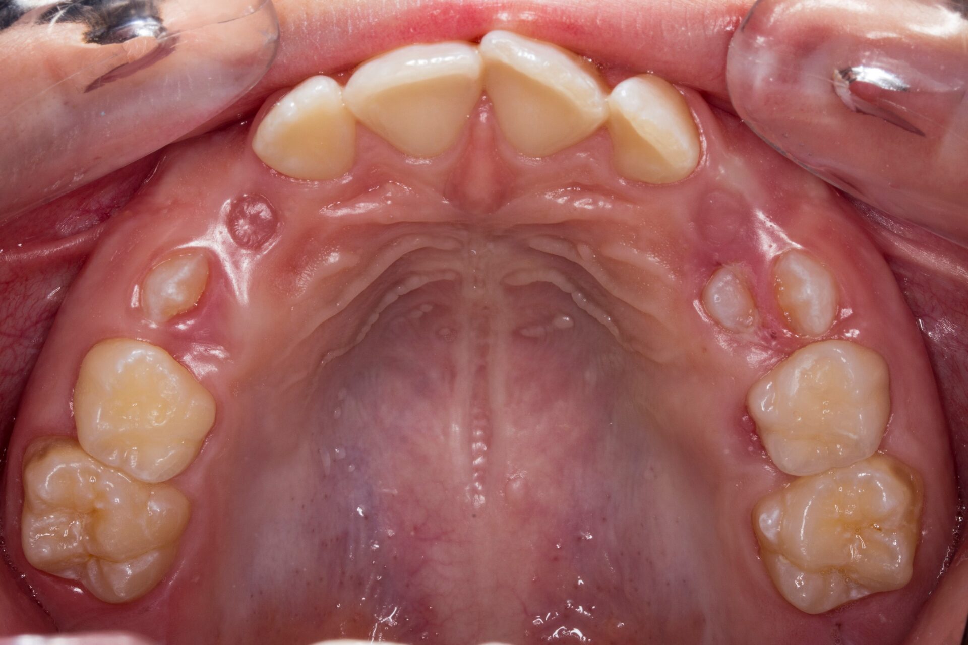 Fotografía oclusal del maxilar superior — inicio del tratamiento