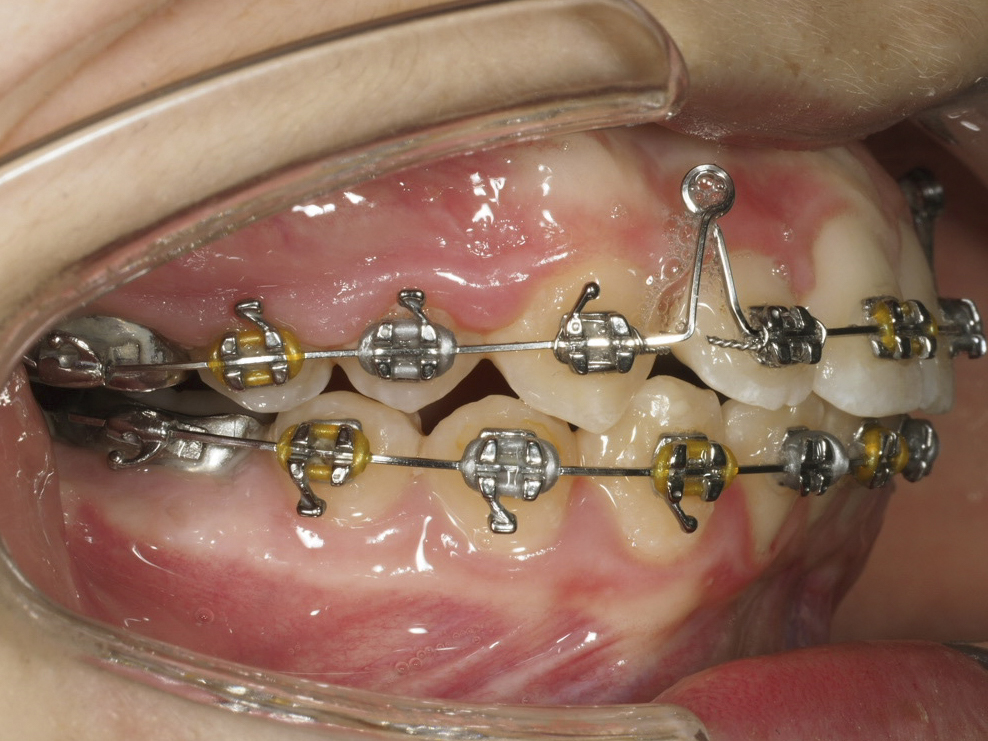 Foto intraoral derecha a los 17 meses con arcos de acero