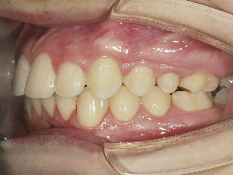 Foto intraoral izquierda al final del tratamiento