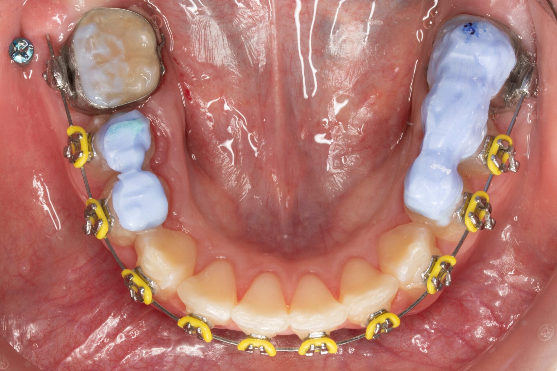 Foto oclusal de la arcada mandibular con aparatología instalada