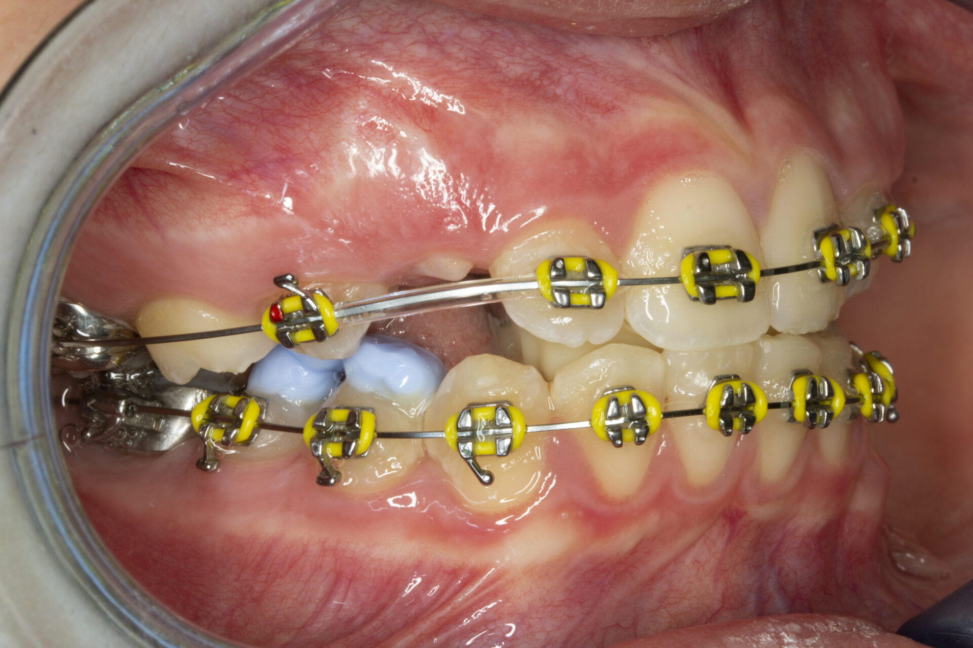 Foto intraoral derecha tras cementado de brackets — inicio del plan de tratamiento
