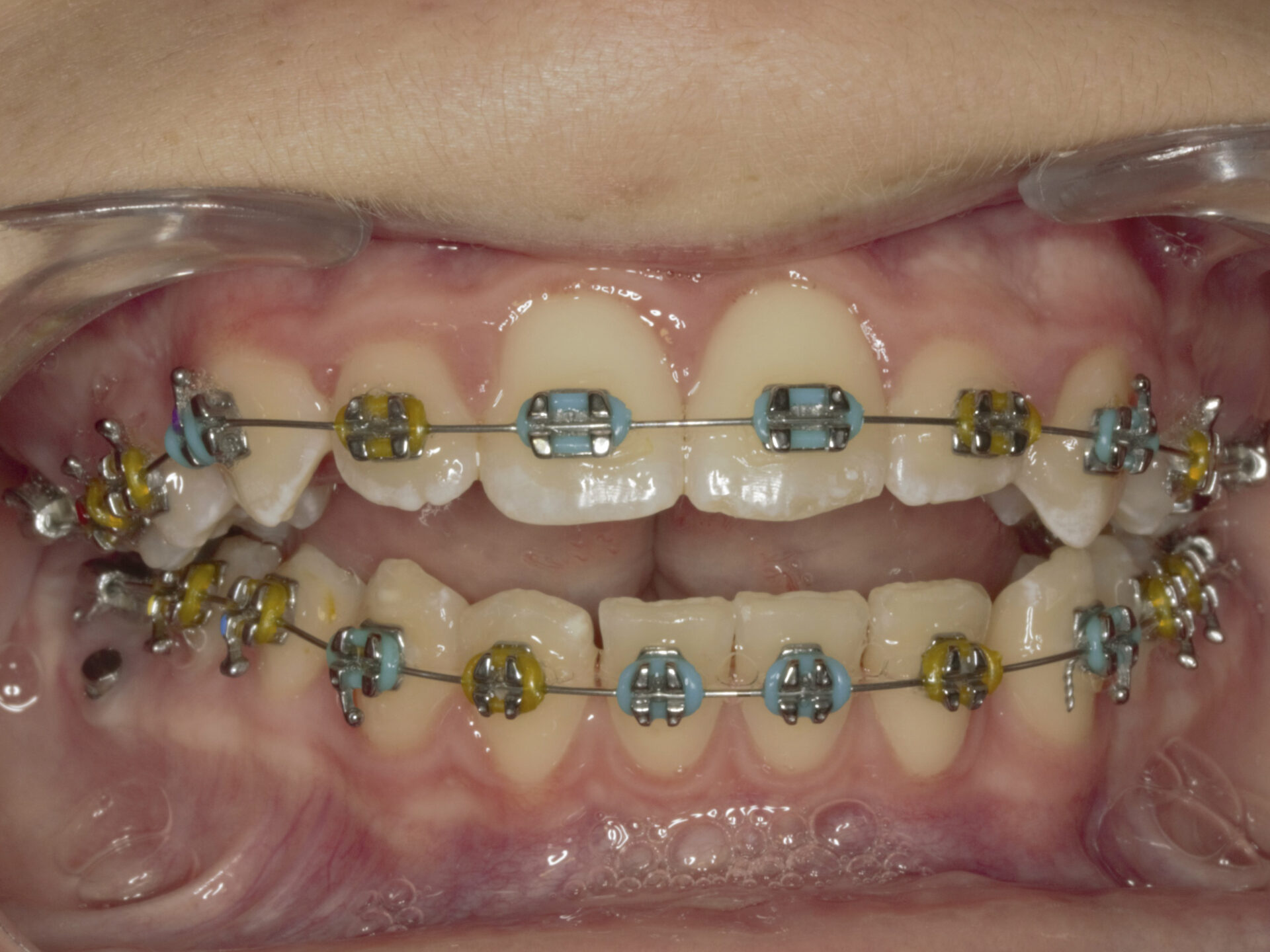 Foto intraoral frontal a los 8 meses de tratamiento