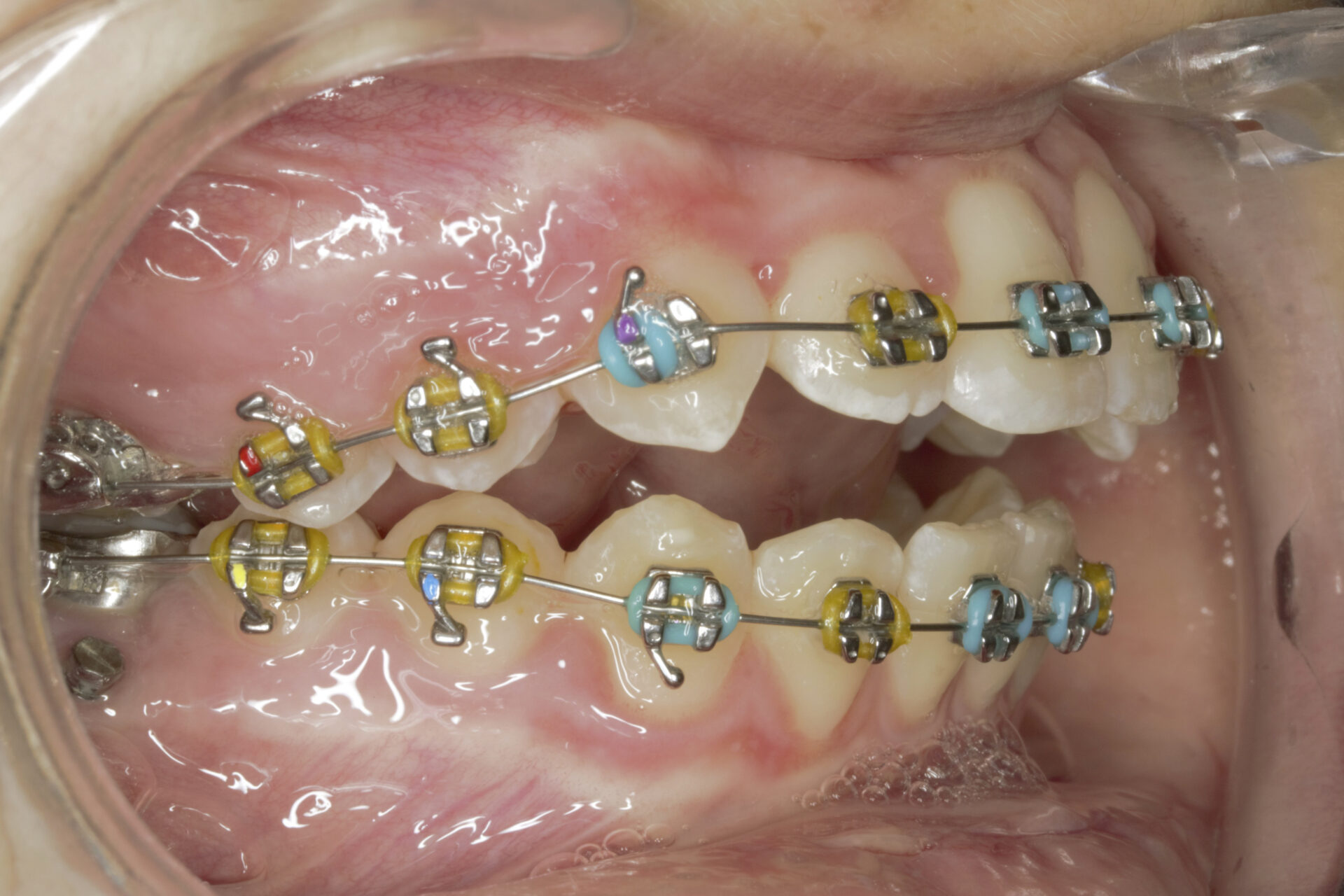 Foto intraoral derecha a los 8 meses de tratamiento