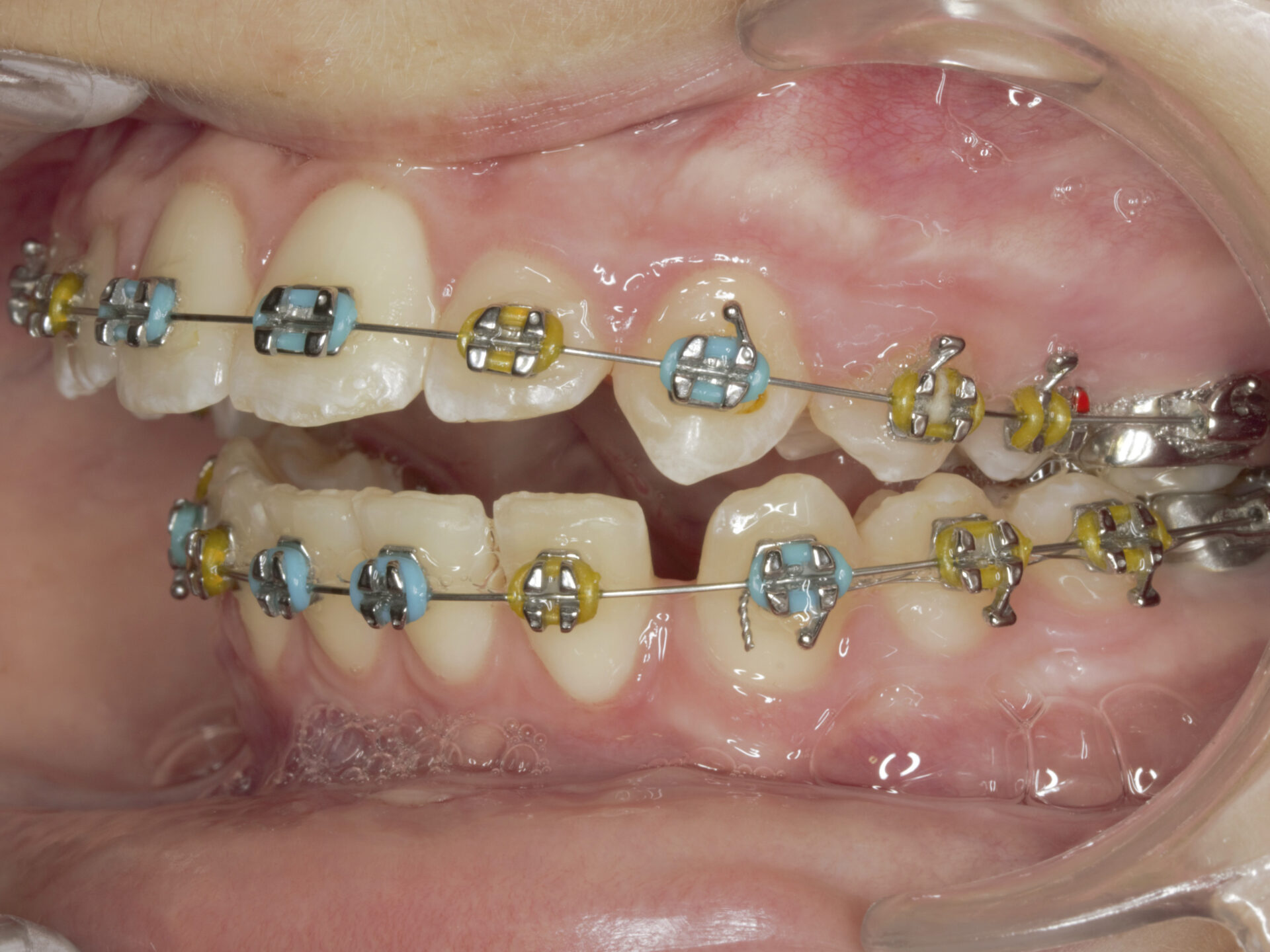 Foto intraoral izquierda a los 8 meses de tratamiento