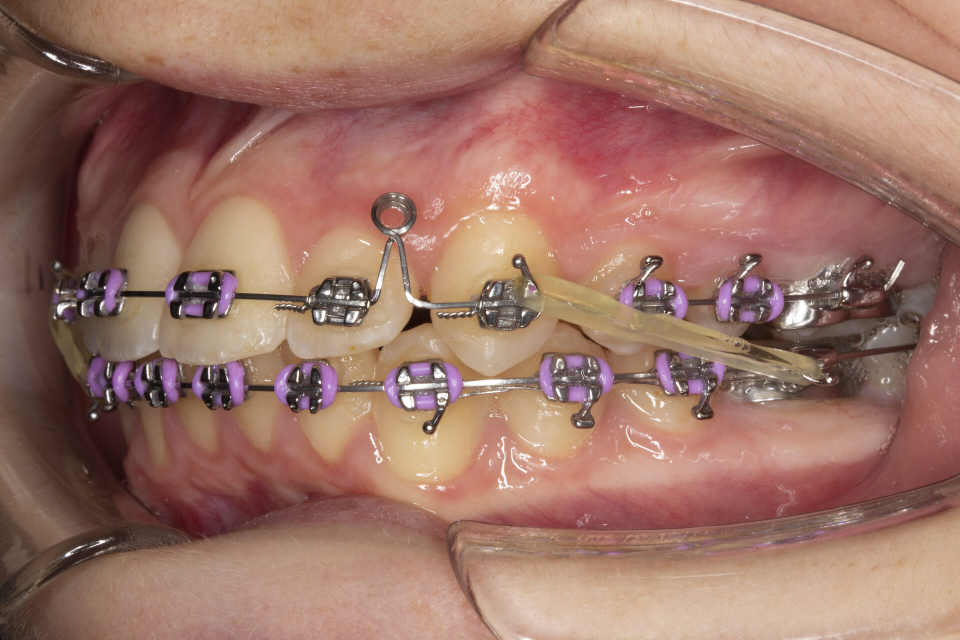 Foto intraoral izquierda a los 20 meses