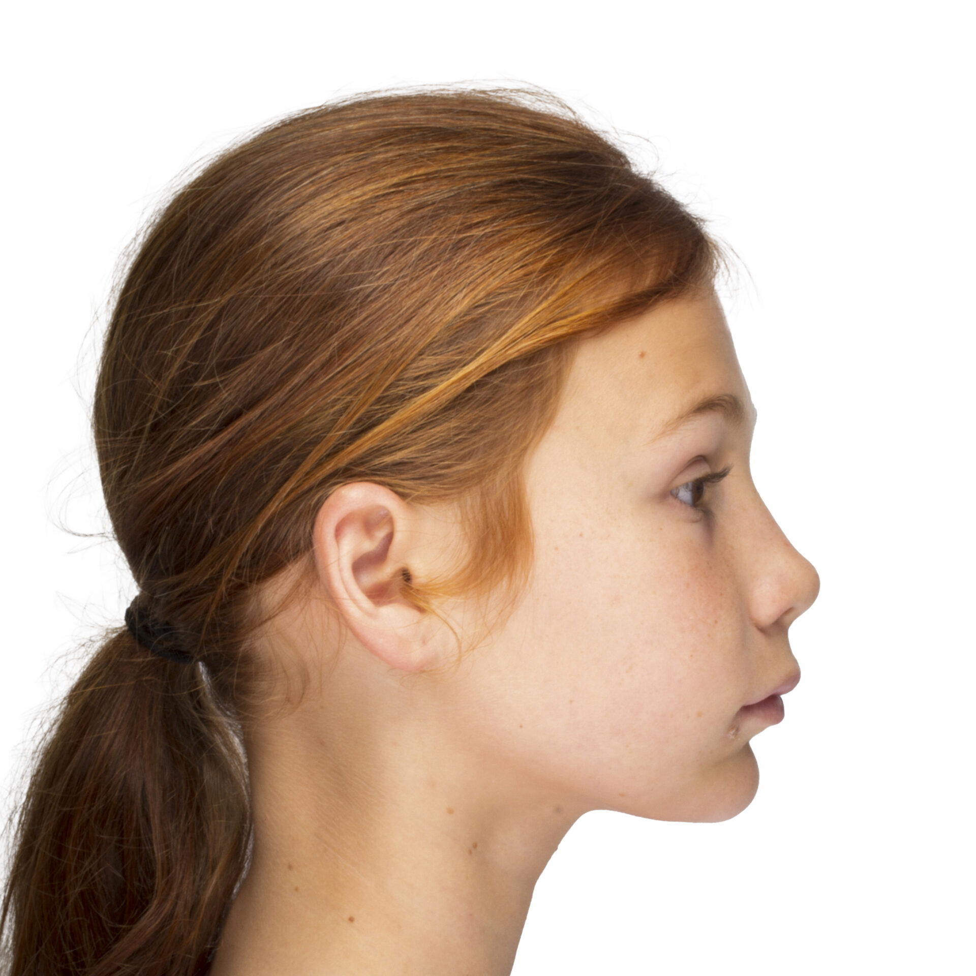 Fotografía de perfil en reposo — retrognatismo mandibular severo