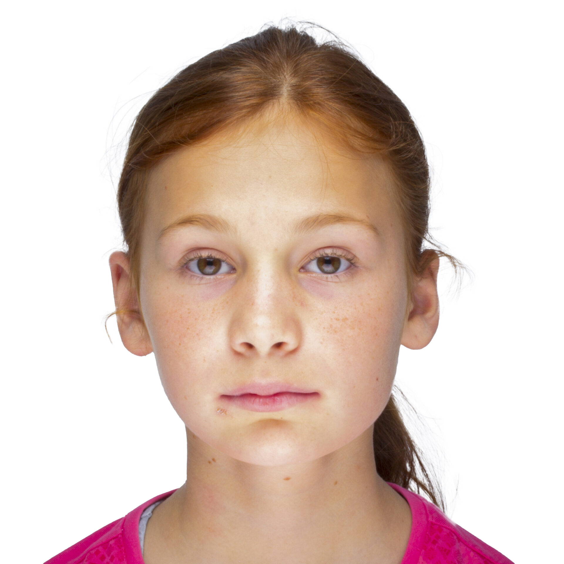 Fotografía facial frontal en reposo de la paciente — inicio del tratamiento