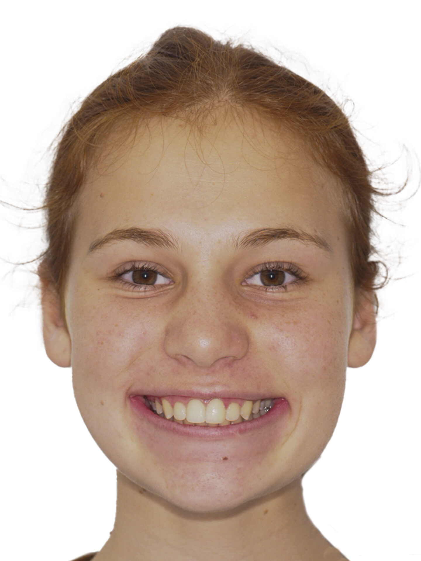 Fotografía facial frontal en sonrisa al final del tratamiento