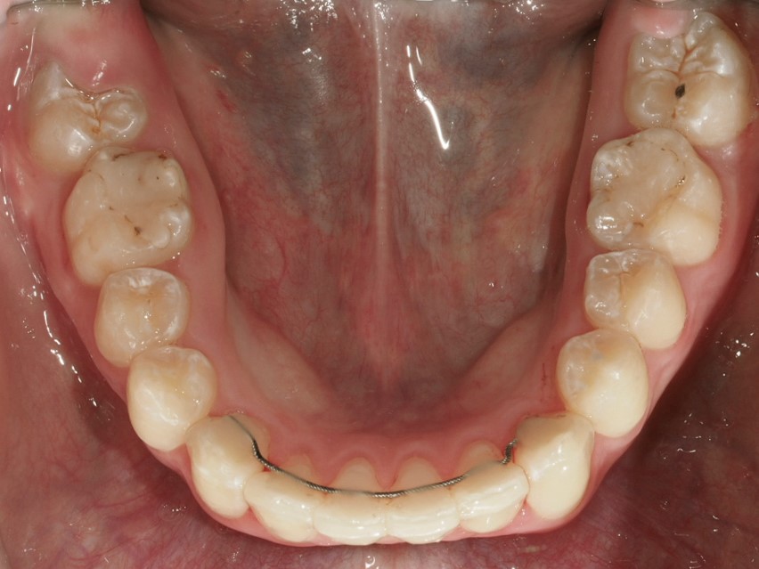 Foto oclusal de la arcada mandibular al final del tratamiento