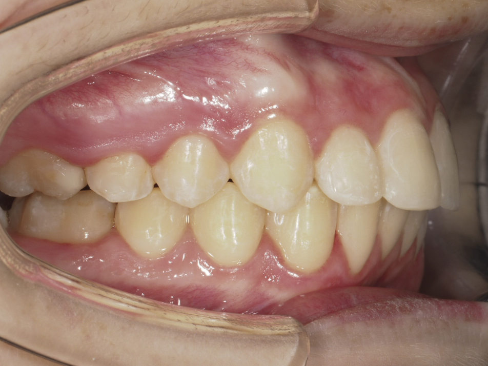 Foto intraoral derecha al final del tratamiento