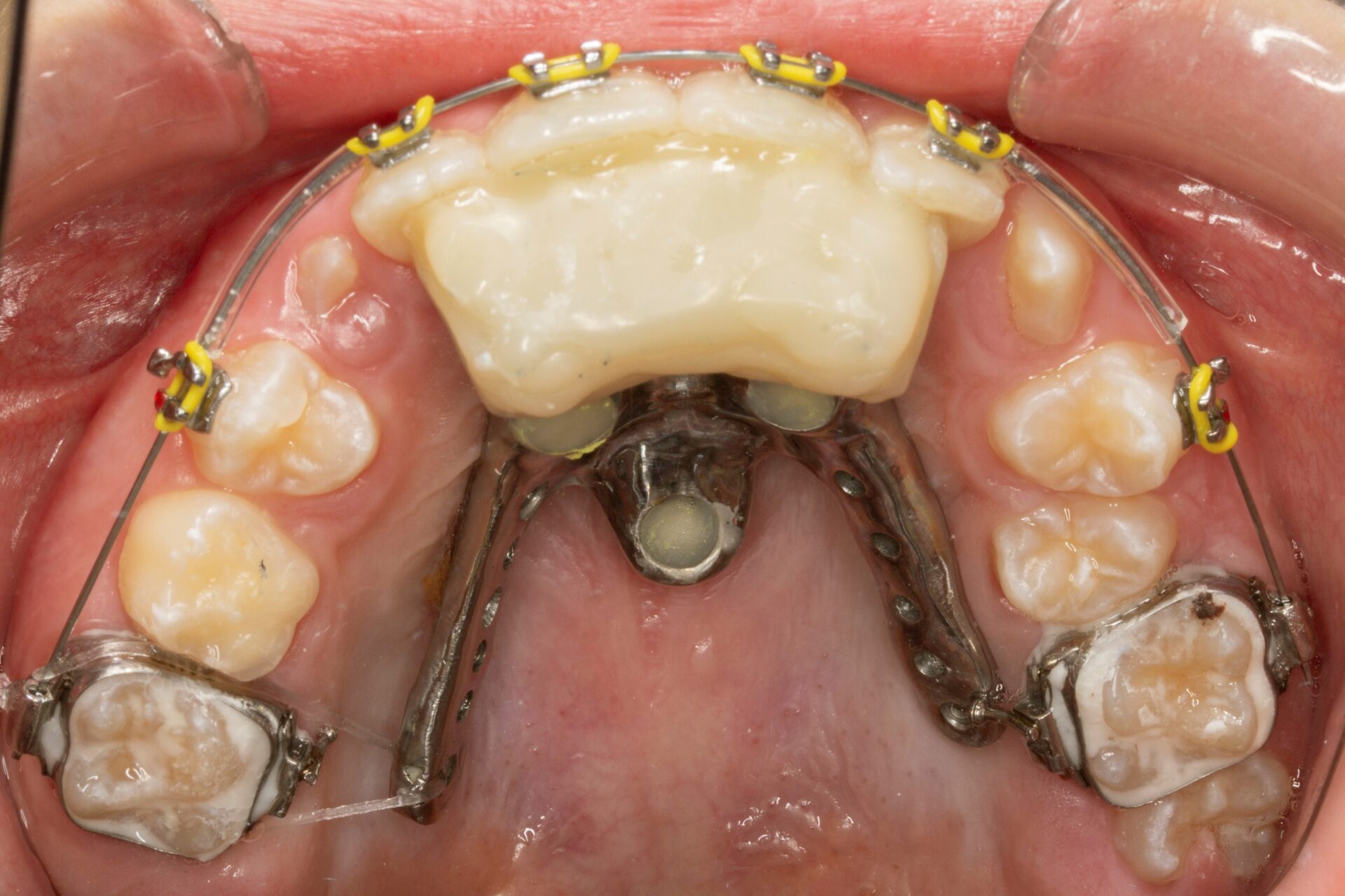 Foto oclusal del maxilar superior con aparatología instalada