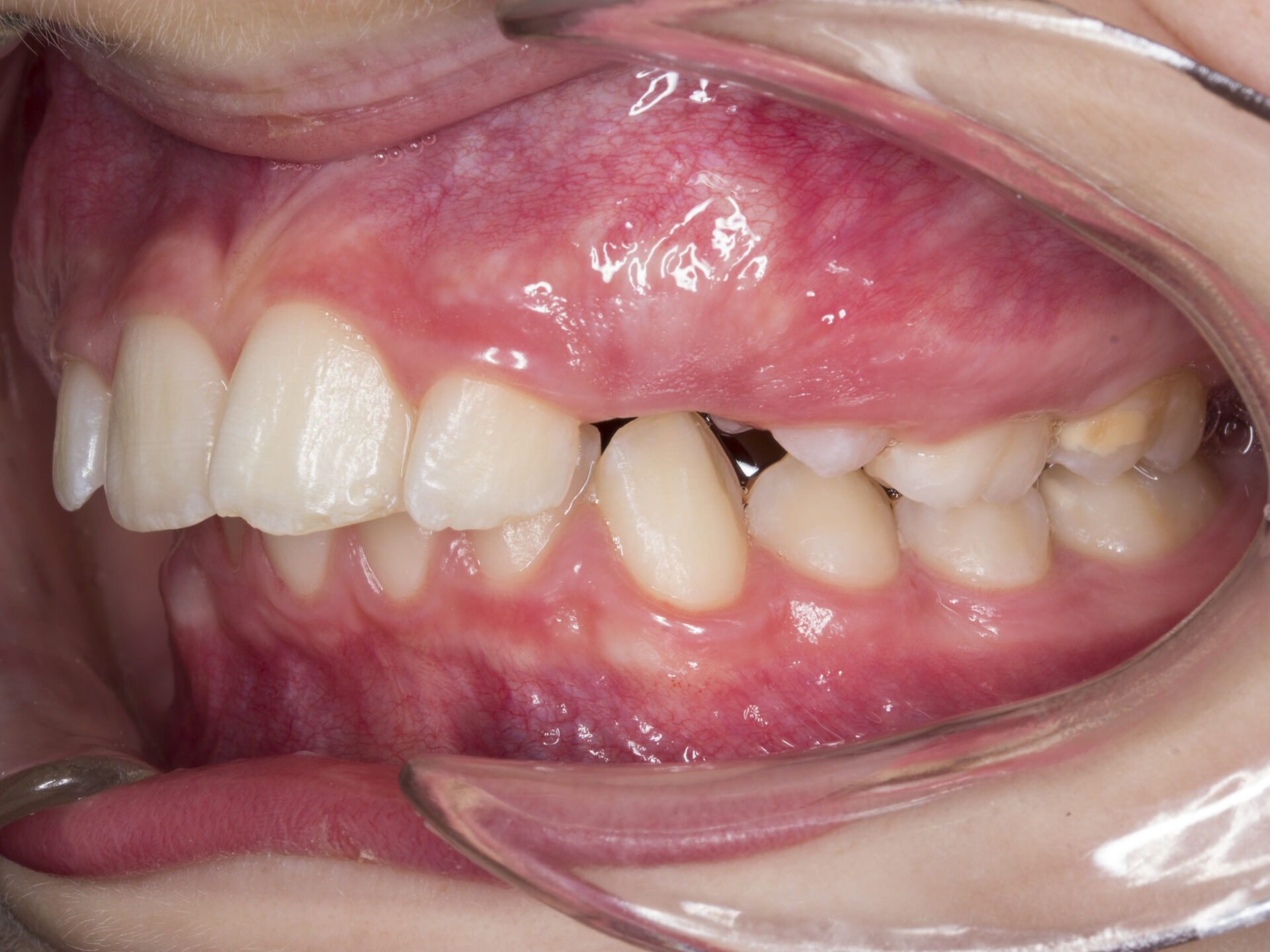 Fotografía intraoral lateral izquierda — inicio del tratamiento