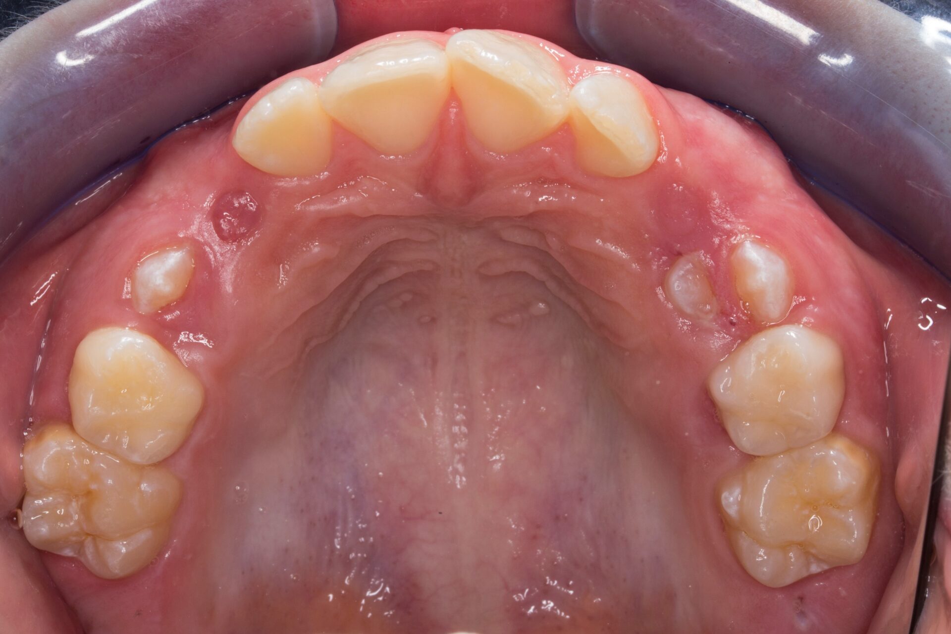 Fotografía oclusal de la arcada mandibular — inicio del tratamiento