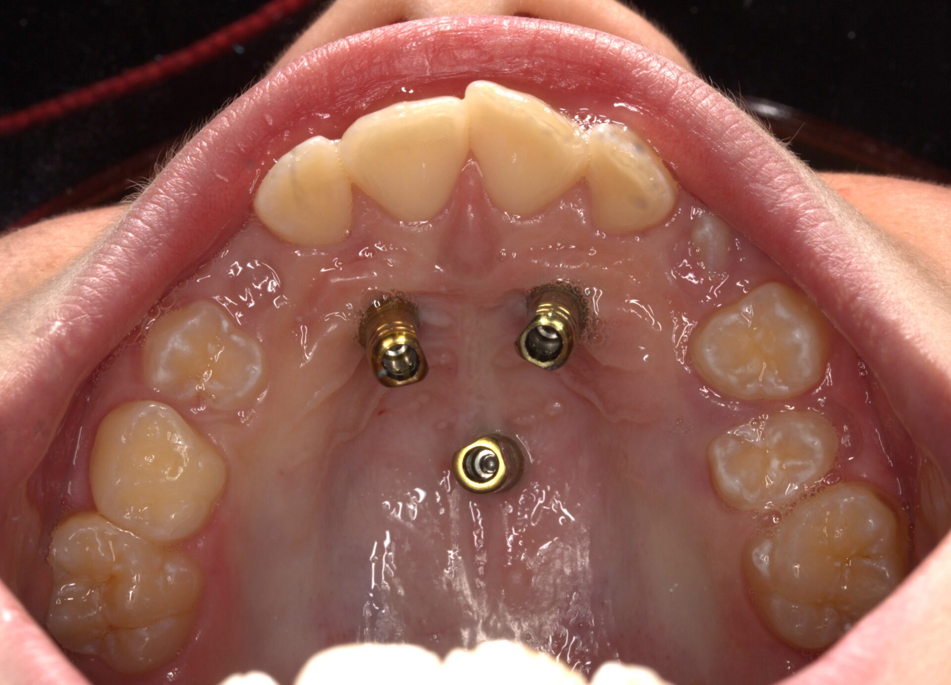 Detalle de los implantes palatinos y estructura colada de anclaje esquelético