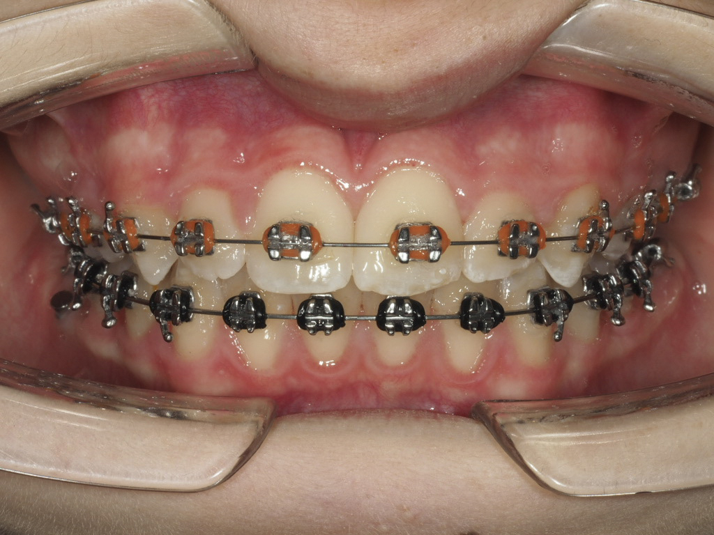 Foto intraoral frontal a los 11 meses de tratamiento